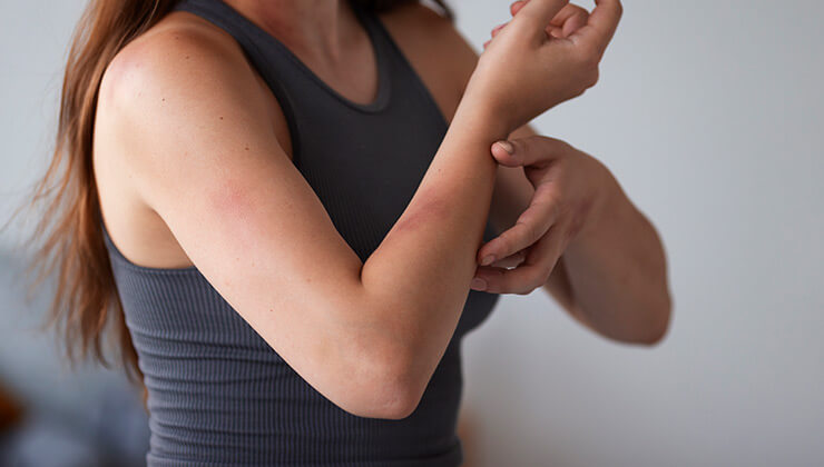 woman with rash on arm