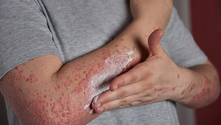 man with psoriasis apply medicated cream