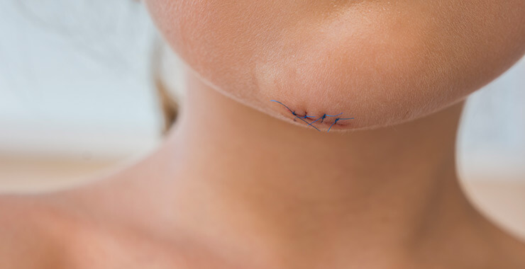 Kid with stitches in chin
