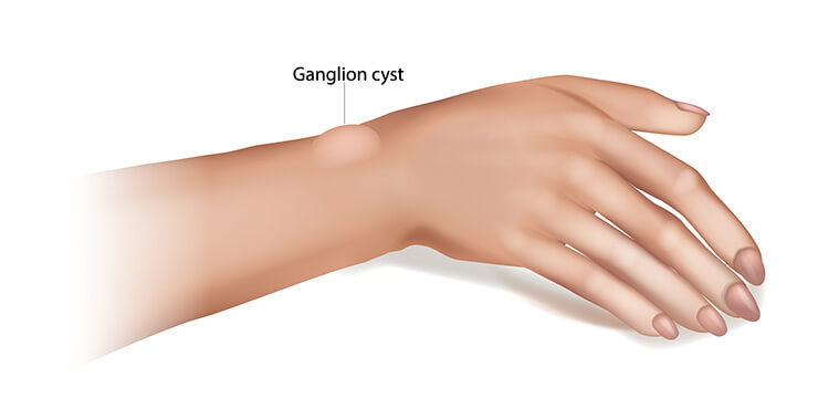 Ganglion Cyst Illustration