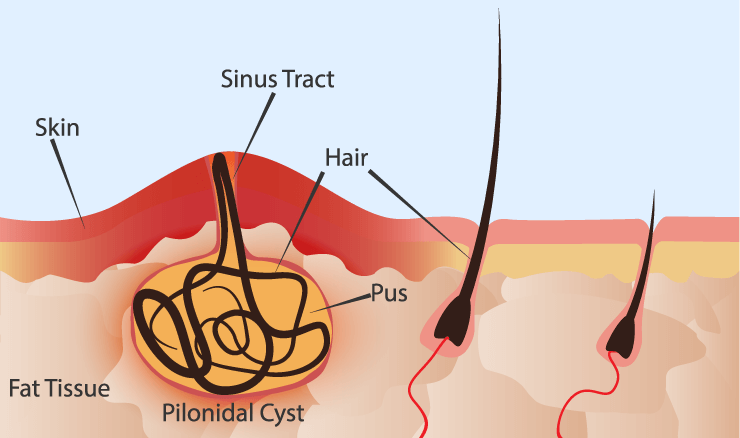 Pilonidal Cyst Illustration
