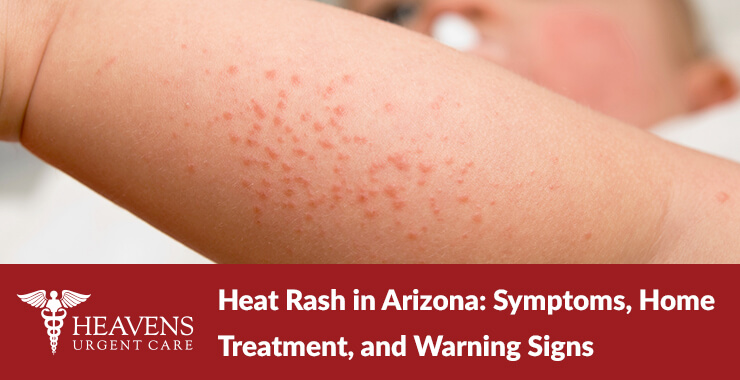 baby with heat rash under leg - Heat Rash in Arizona