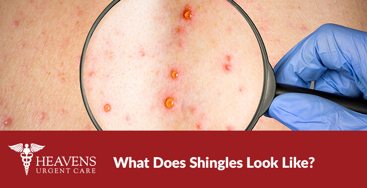a gloved hand holding a magnifying glass over what does shingles look like